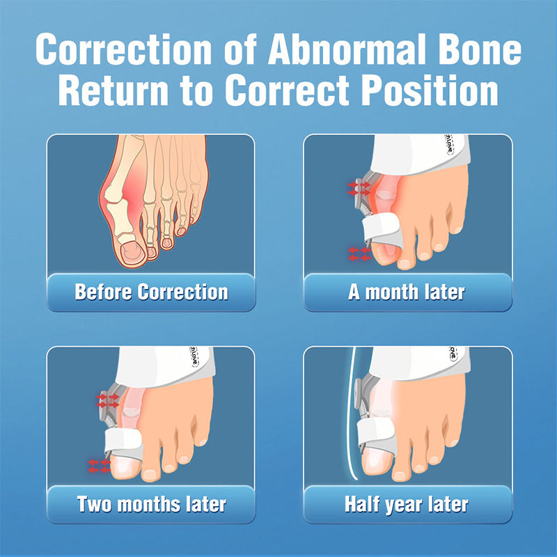 Upgraded Bunion Corrector - 3D Knob Toe Corrector